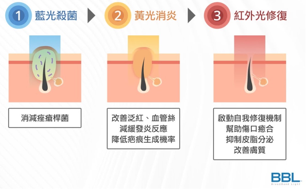 青春光耀BBL推薦治療痘痘唷，台北名醫表示BBLFoeverClear恆淨豆豆模式也很多人用來治療痘痘。