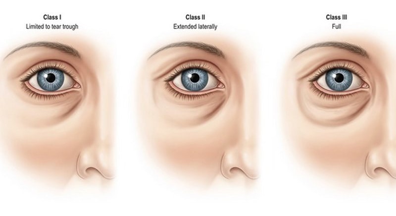 消除黑眼眼圈推薦醫美療程，會根據不同的黑眼圈類型而有不同